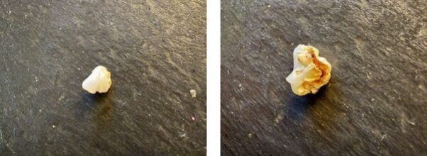 Upper East Sider Reports Finding Tooth in Food Delivery Order